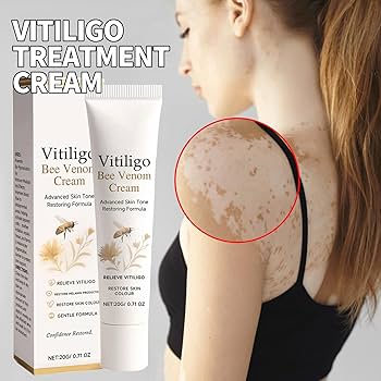 Vitiligo Removal Cream AED 10